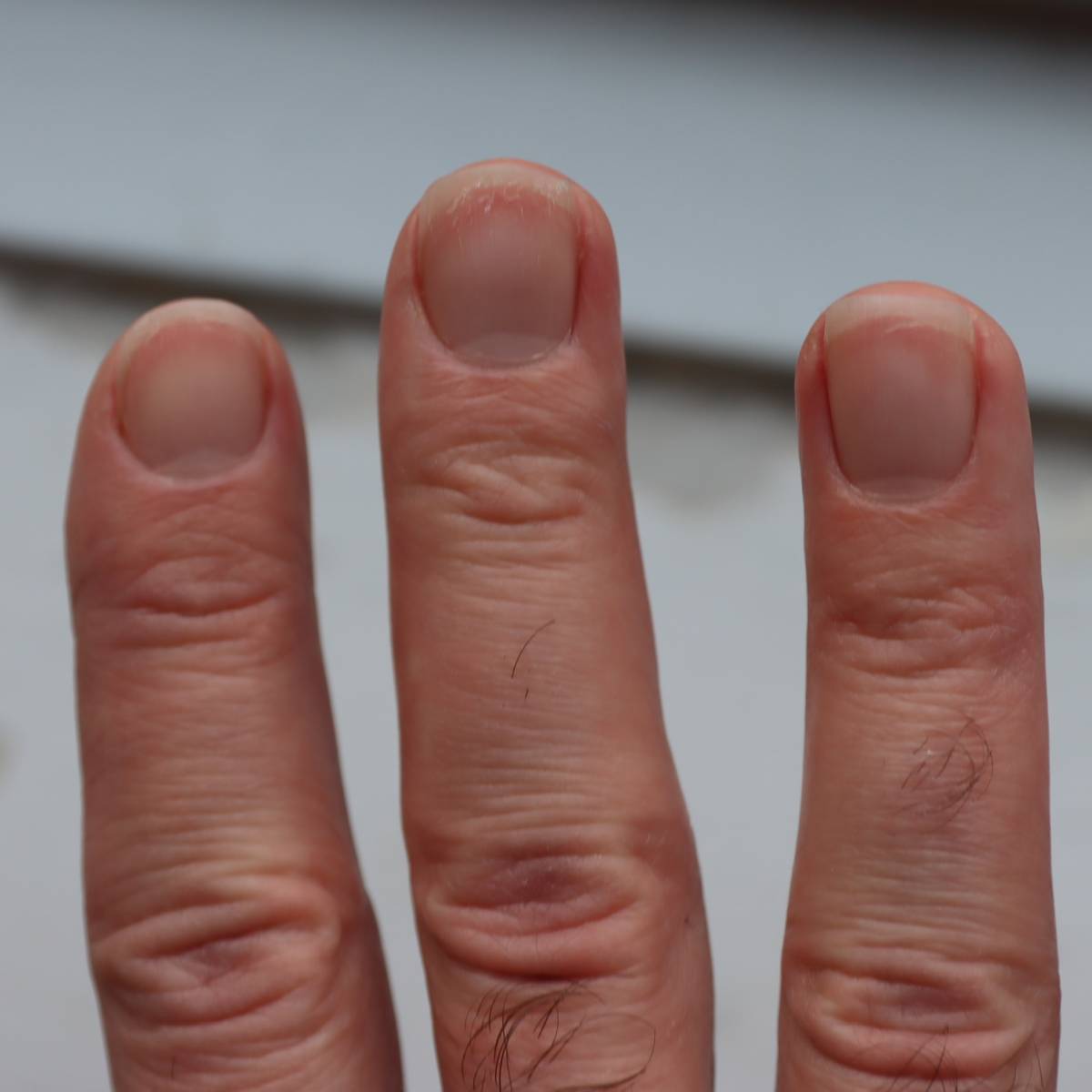 An image of the fingernails of the right hand which are dry and peeling