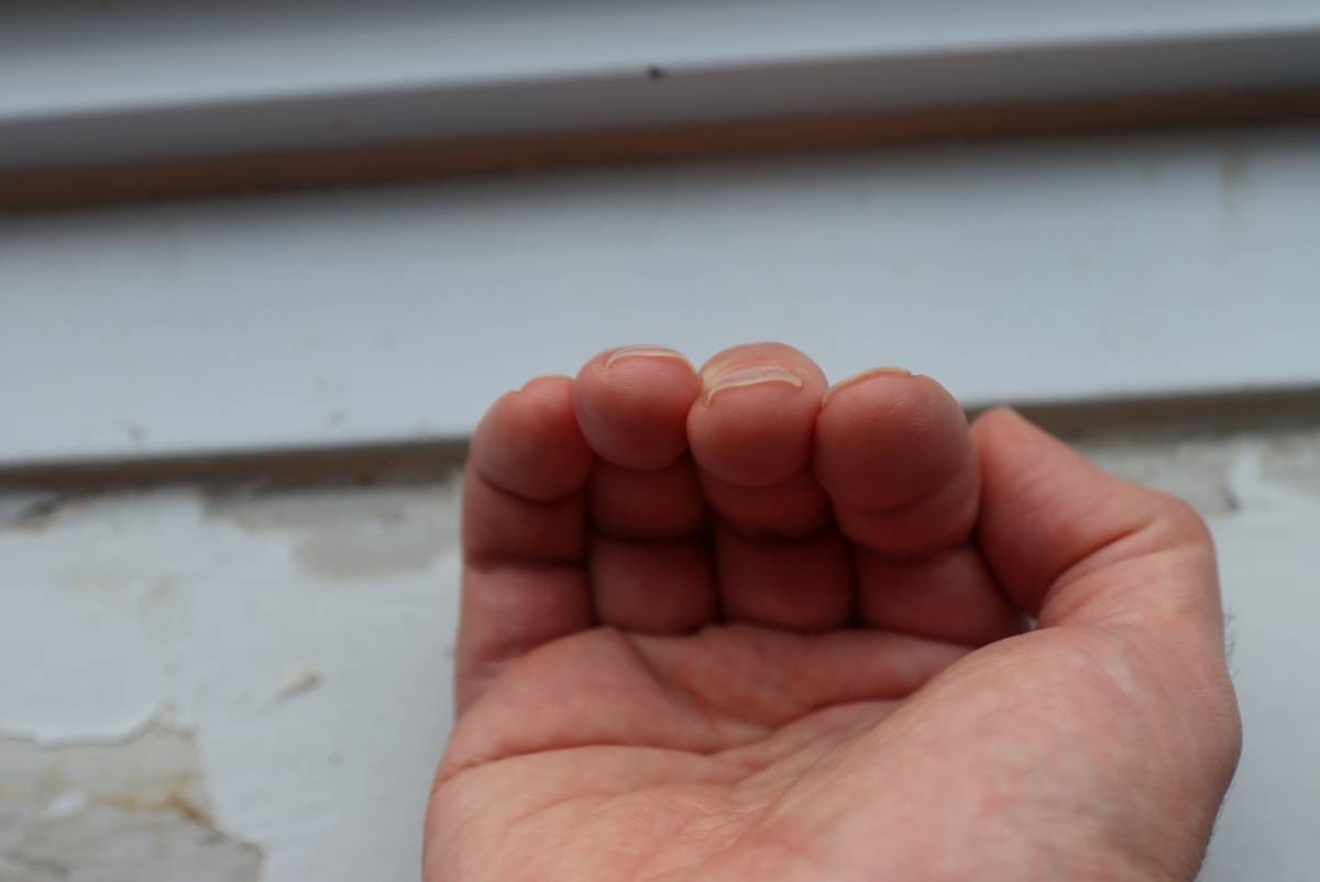 An image of the tips of the fingernail which should be straight across